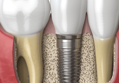 implant1-min implant1-min