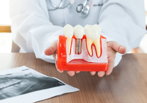 Dental Implants Airdrie